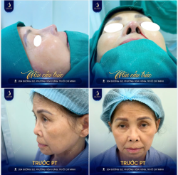 NÂNG MŨI CẤU TRÚC – ĐƯỜNG NÉT THANH THOÁT, DIỆN MẠO TRẺ TRUNG
