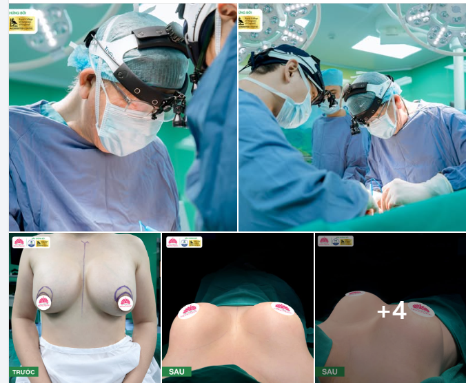 "GIẢI CỨU" V1 BIẾN DẠNG SAU NÂNG NGỰC LỖI, HỎNG  PHỤC HỒI TUYẾN VÚ - TÁI KIẾN TẠO V1 CĂNG TRÒN, MỀM MẠI, ĐẸP AN TOÀN, BỀN VỮNG