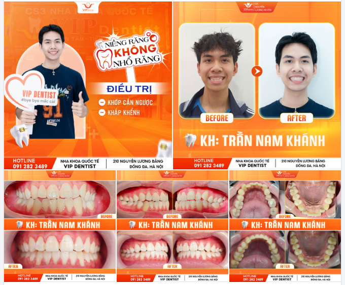 BỪNG SÁNG NỤ CƯỜI - HÓA "SOÁI CA" SAU NIỀNG RĂNG
