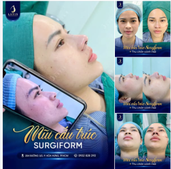 NÂNG MŨI SURGIFORM – SỐNG CAO RÕ NÉT, CHÂN CÁNH GỌN