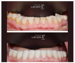 MÒN RĂNG Ở TUỔI TRUNG NIÊN - CÓ PHẢI DO TUỔI TÁC?