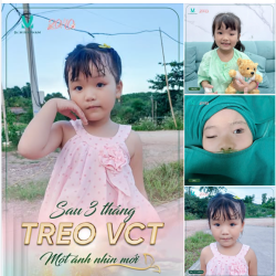 Sau 3 tháng điều trị đôi mắt của bé đã hoàn toàn ổn định, nếp mí tự nhiên và hài hòa hơn