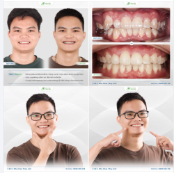 NIỀNG RĂNG ĐỔI NỤ CƯỜI MỚI - NÂNG TẦM TỰ TIN NAM GIỚI HIỆN ĐẠI