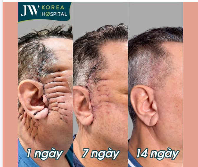 CẬN CẢNH ĐƯỜNG MỔ CĂNG DA MẶT SMAS PRO TẠI JW: NÂNG CƠ TRẺ 20 TUỔI, SẸO TÀNG HÌNH