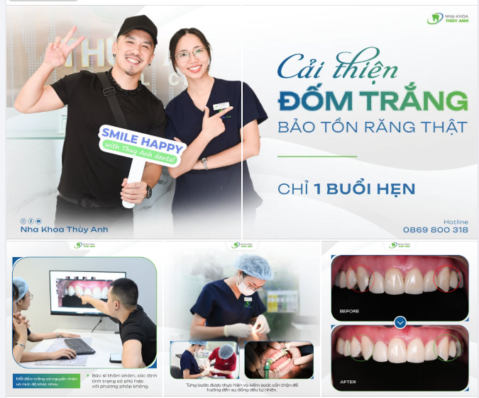 1 BUỔI HẸN CẢI THIỆN ĐỐM TRẮNG TRÊN RĂNG CHO NỤ CƯỜI THÊM TỰ TIN
