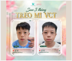 KHÁNH QUANG SAU 3 THÁNG TREO MI VCT – KẾT QUẢ ỔN ĐỊNH, BỐ MẸ AN TÂM