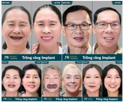 CÔ CHÚ 50-80 TUỔI MẤT RĂNG LÂU NĂM, ĂN NHAI KHÓ KHĂN? TRỒNG RĂNG IMPLANT TẠI JW – TÌM LẠI NỤ CƯỜI, ĂN NGON VÀ SỐNG TỰ TIN HƠN!