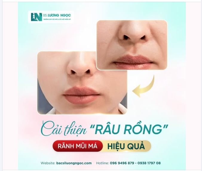 RÃNH MŨI MÁ SÂU – ĐỪNG ĐỂ ĐƯỜNG NÉT KHUÔN MẶT KHIẾN BẠN TRÔNG GIÀ HƠN TUỔI