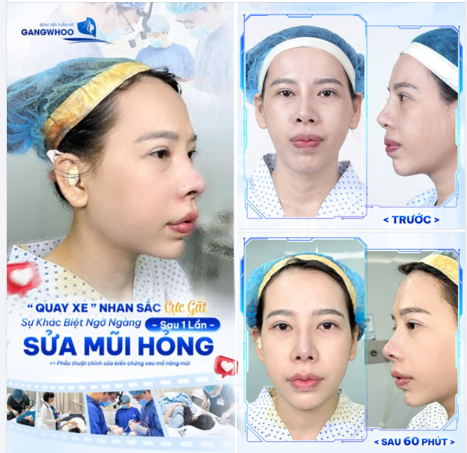 MÀN "QUAY XE" NHAN SẮC CỰC GẮT SAU SỬA MŨI LẠI LẦN 2