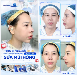 MÀN "QUAY XE" NHAN SẮC CỰC GẮT SAU SỬA MŨI LẠI LẦN 2