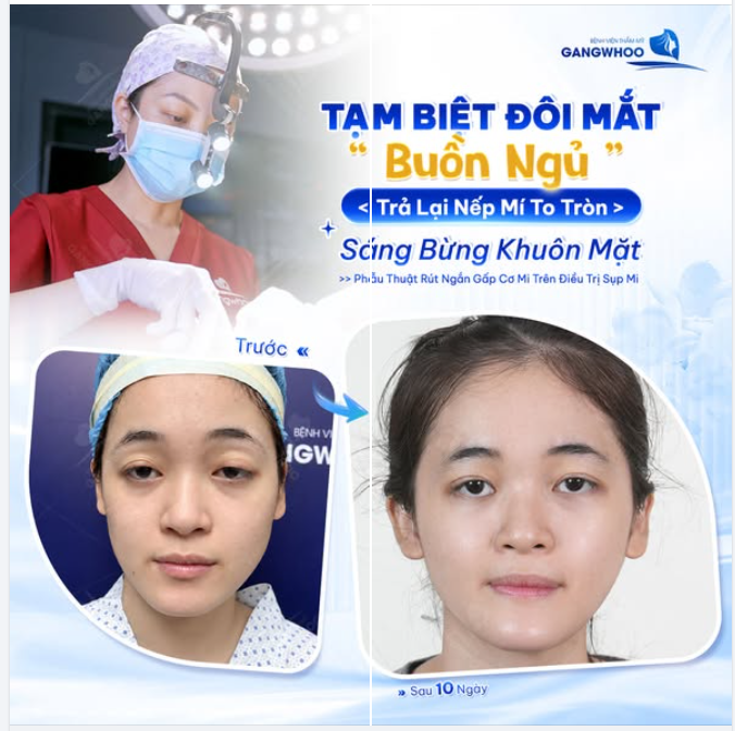 TẠM BIỆT ĐÔI MẮT "BUỒN NGỦ"