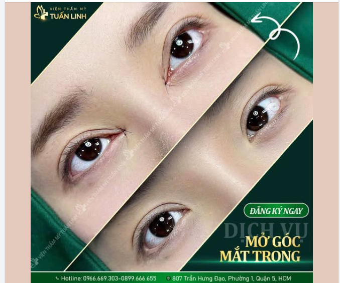 MỞ GÓC MẮT TRONG – ÁNH NHÌN THÊM HÚT, ĐÔI MẮT THÊM THANH TÚ