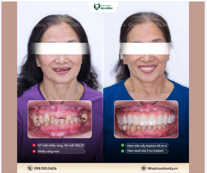 QUYẾT ĐỊNH TRỒNG RĂNG - ĂN NHAI THOẢI MÁI, CUỘC SỐNG SANG TRANG