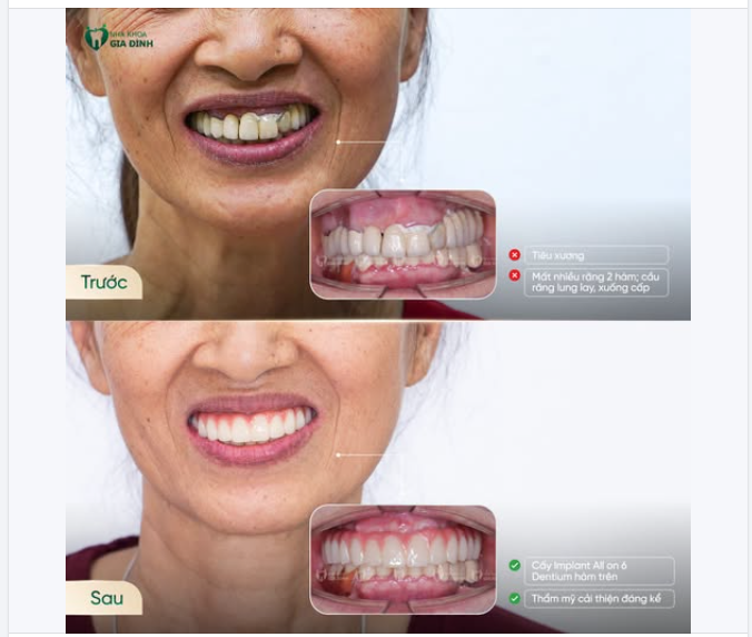TỪ HÀM RĂNG XUỐNG CẤP ĐẾN NỤ CƯỜI TRỌN VẸN