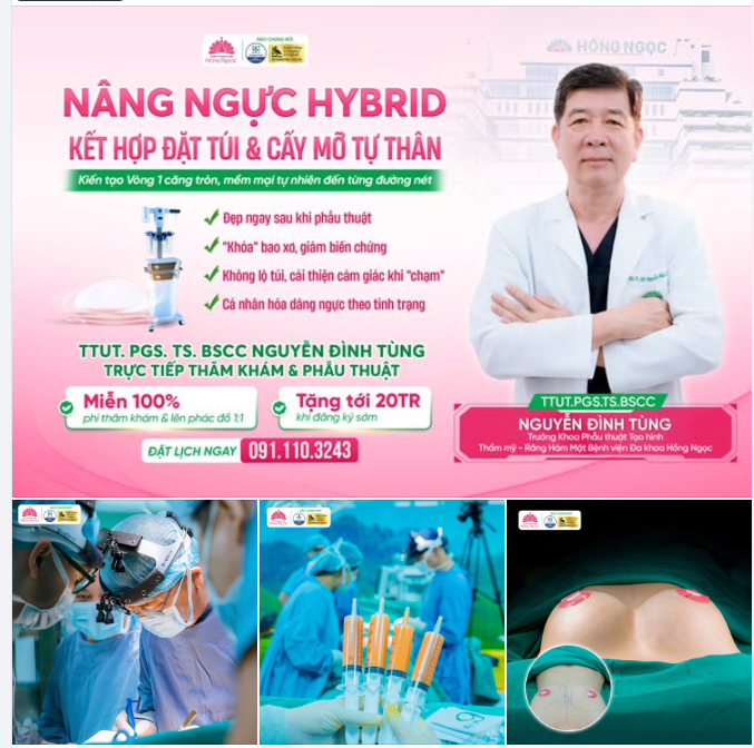 NÂNG NGỰC HYBRID - KẾT HỢP ĐẶT TÚI VÀ CẤY MỠ TỰ THÂN