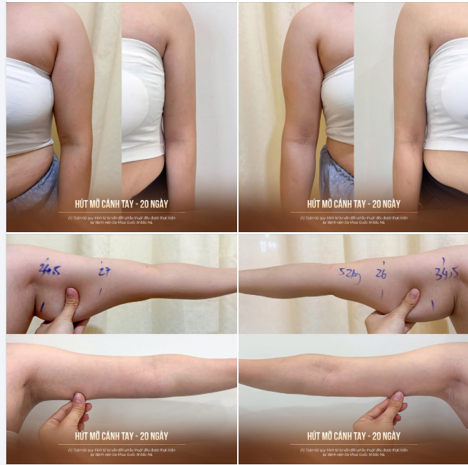 "XỬ LÝ" VÙNG MỠ KHÓ GIẢM BẰNG CÔNG NGHỆ VASER LIPO