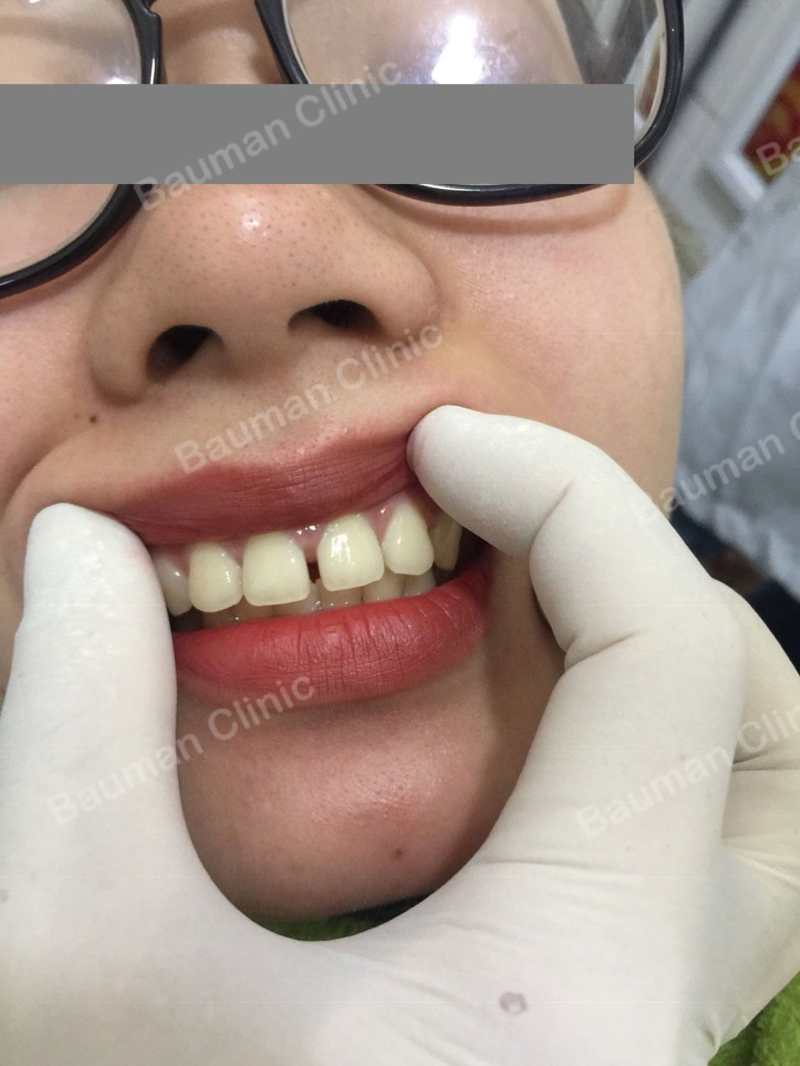 Ca niềng răng số 5037 - Nha khoa Bauman Clinic
