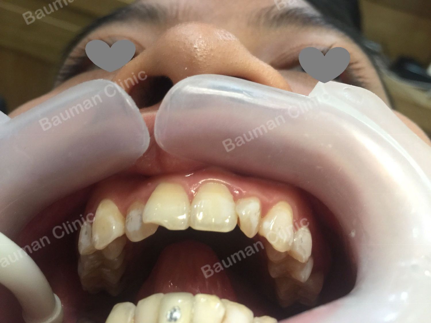 Ca niềng răng số 5071 - Nha khoa Bauman Clinic