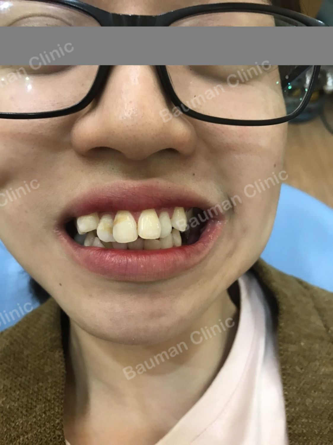 Ca niềng răng số 5085 - Nha khoa Bauman Clinic