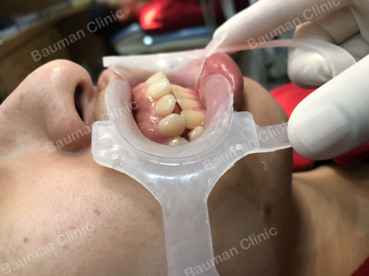Ca niềng răng số 5093 - Nha khoa Bauman Clinic