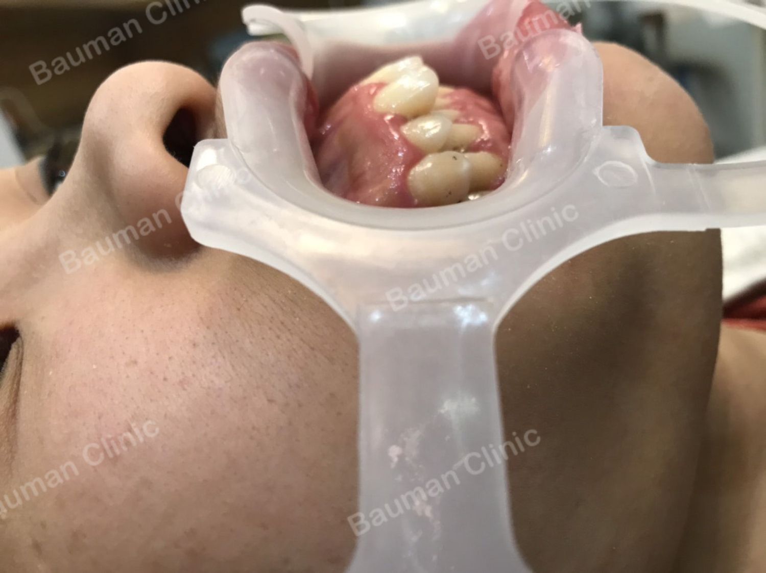 Ca niềng răng số 5094 - Nha khoa Bauman Clinic
