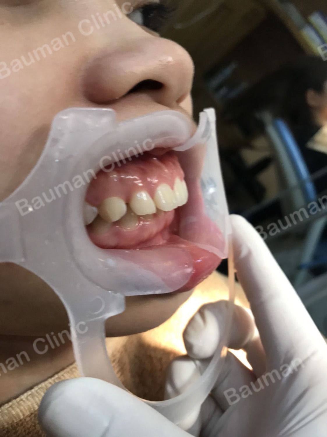 Ca niềng răng số 5096 - Nha khoa Bauman Clinic