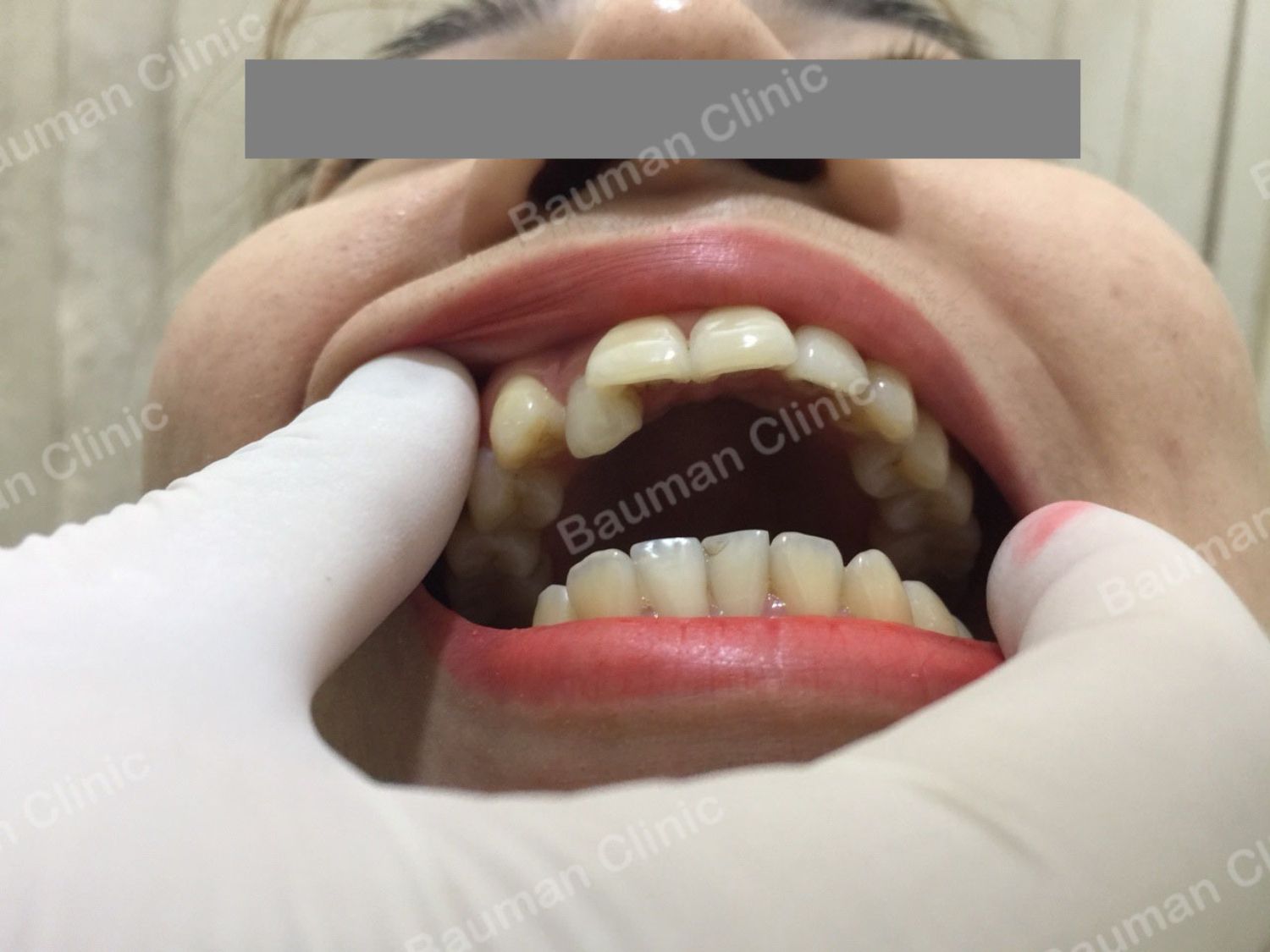 Ca niềng răng số 5026 - Nha khoa Bauman Clinic