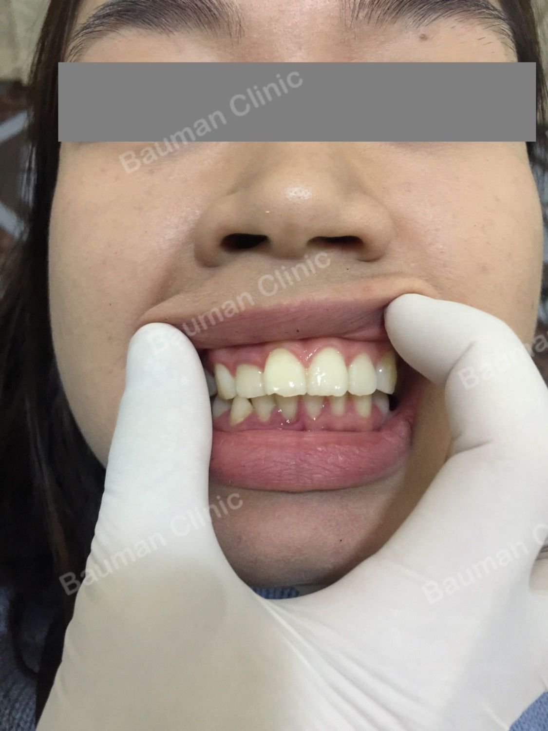 Ca niềng răng số 5028 - Nha khoa Bauman Clinic