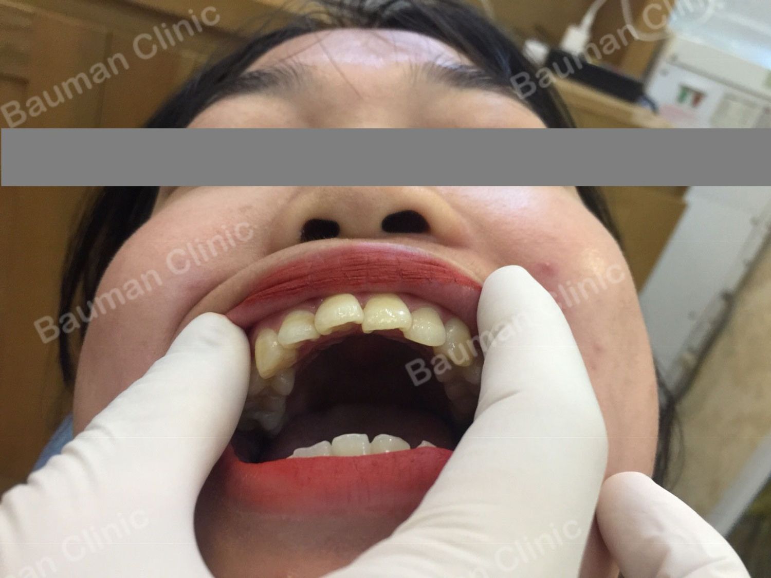 Ca niềng răng số 5051 - Nha khoa Bauman Clinic