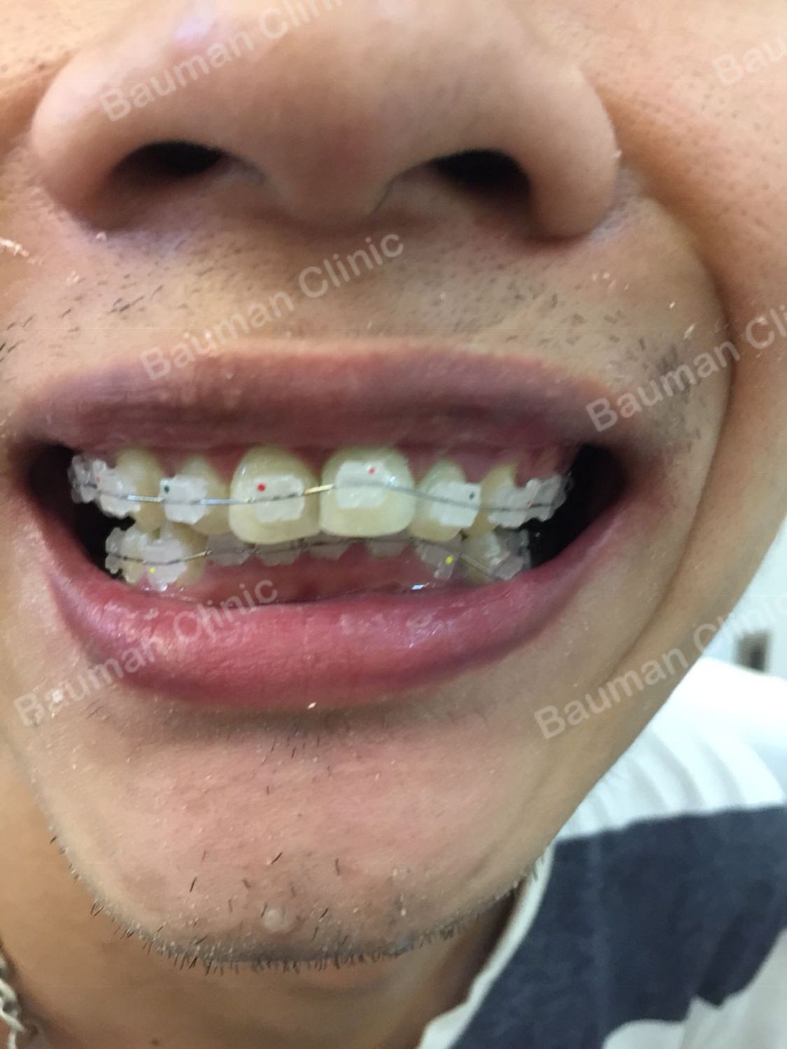 Ca niềng răng số 5055 - Nha khoa Bauman Clinic