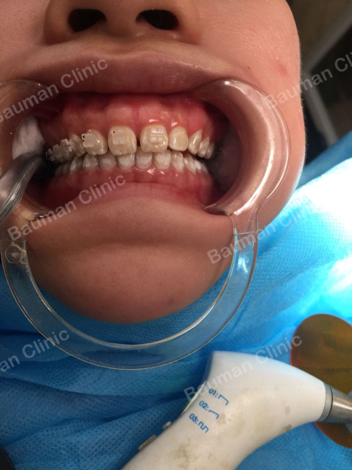 Ca niềng răng số 5063 - Nha khoa Bauman Clinic