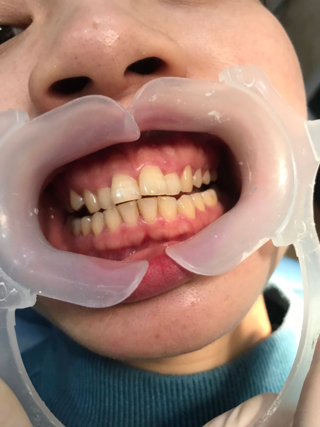 Ca niềng răng số 5090 - Nha khoa Bauman Clinic