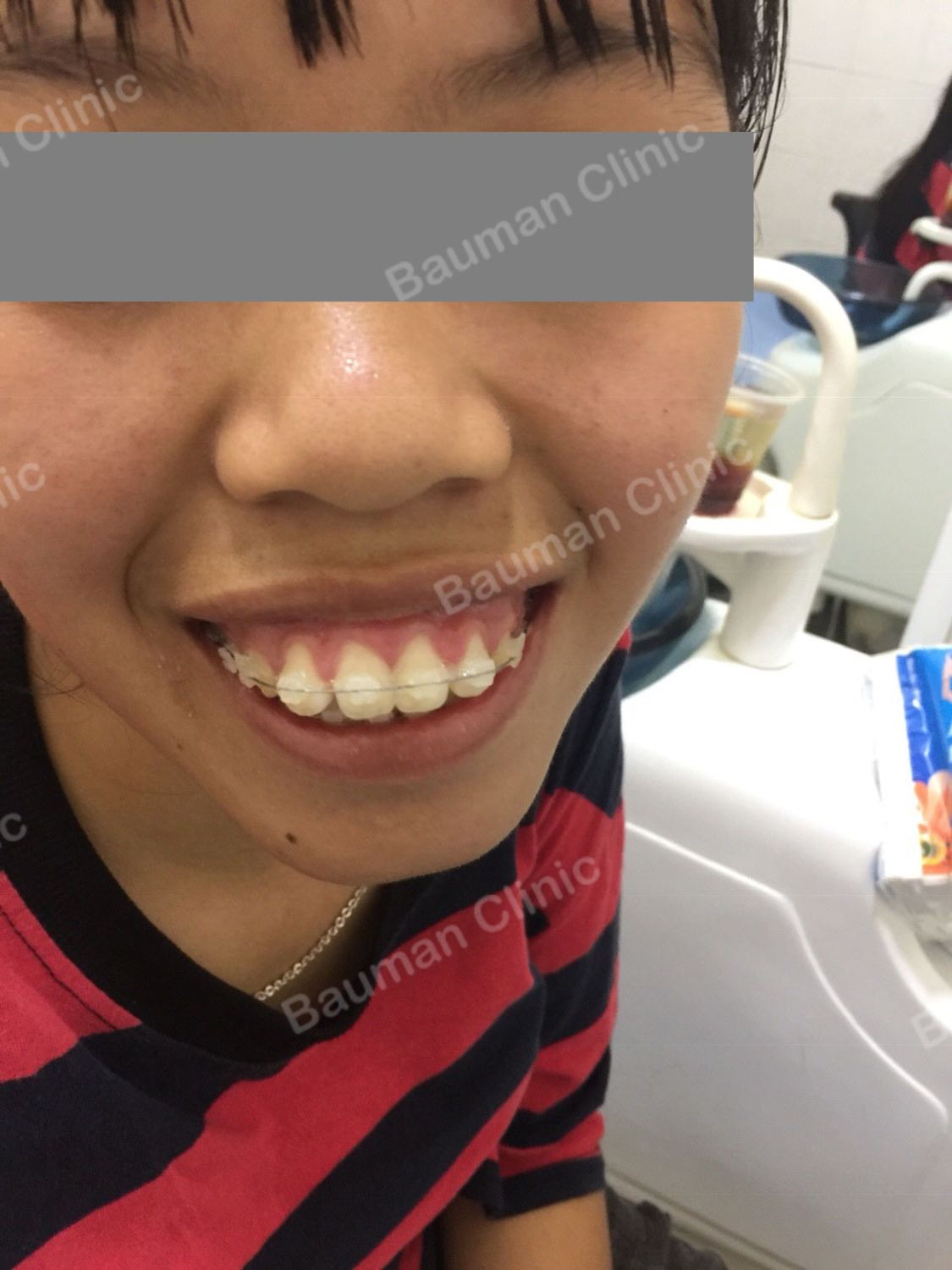 Ca niềng răng số 5030 - Nha khoa Bauman Clinic