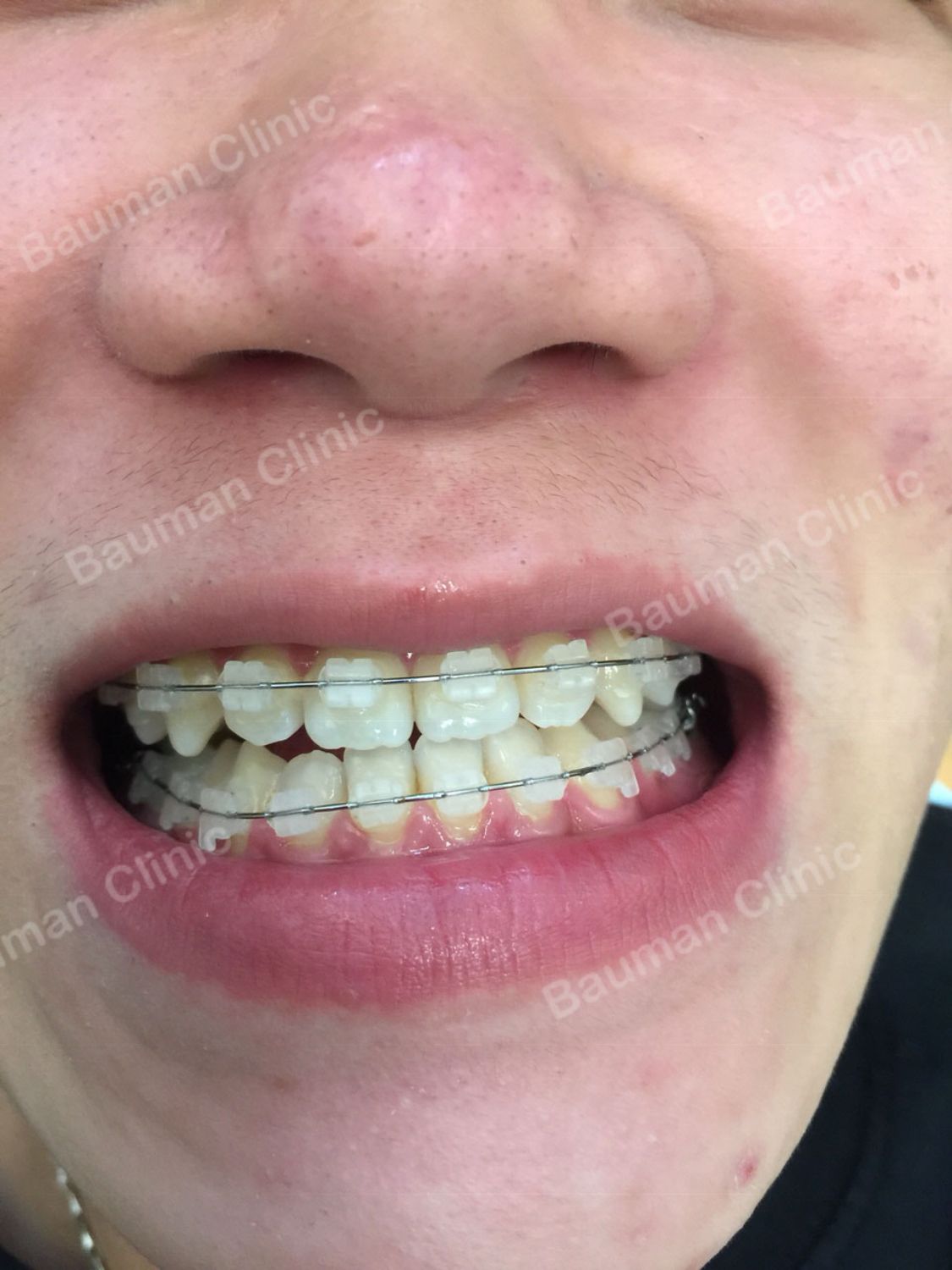 Ca niềng răng số 5035 - Nha khoa Bauman Clinic