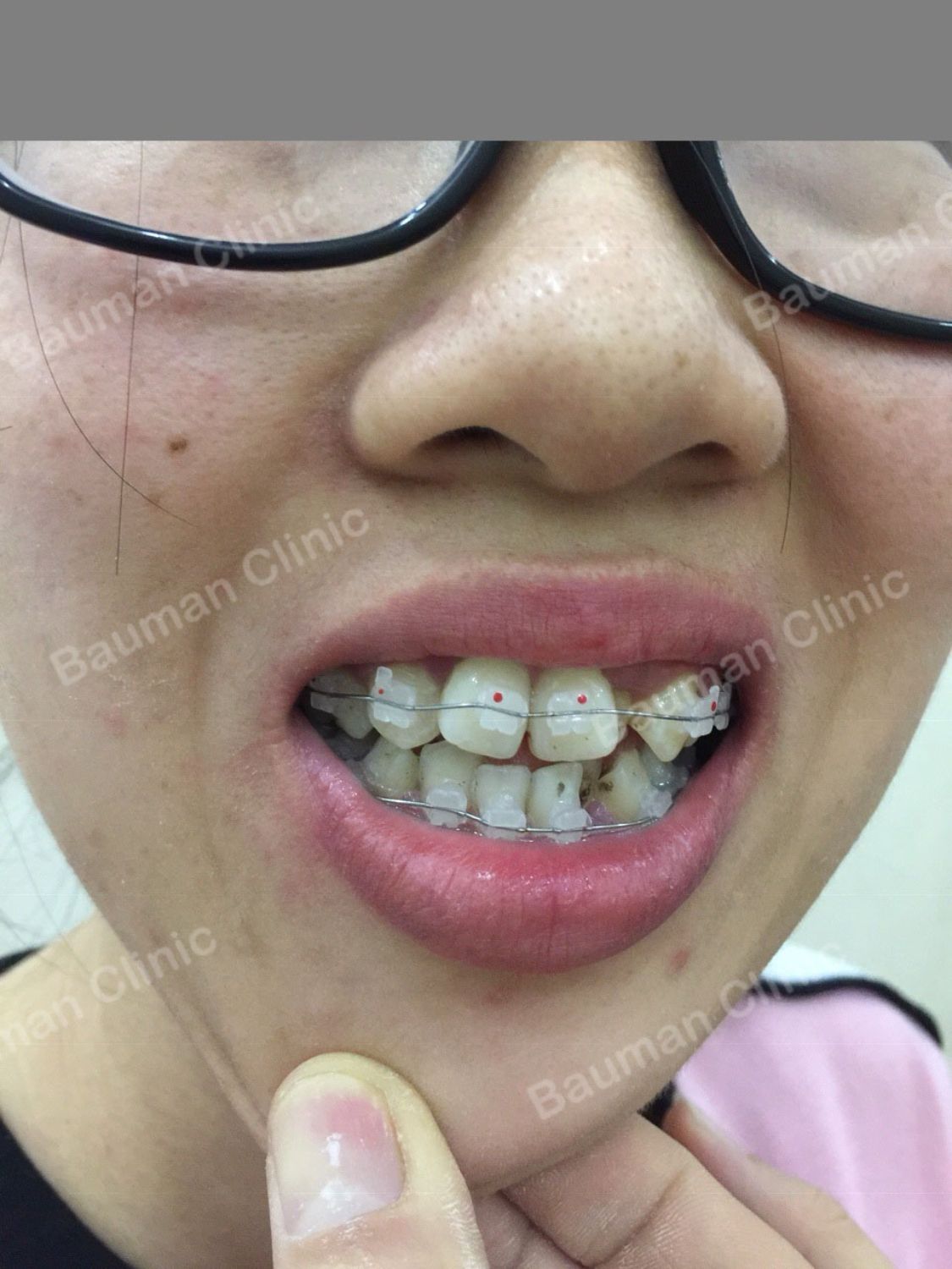 Ca niềng răng số 5040 - Nha khoa Bauman Clinic