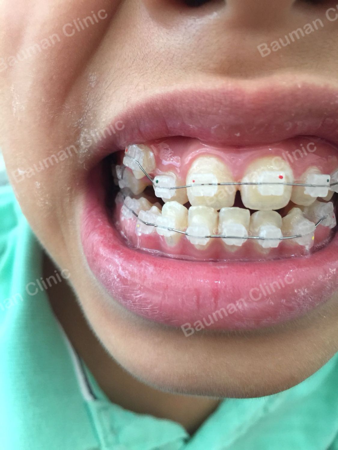 Ca niềng răng số 5058 - Nha khoa Bauman Clinic