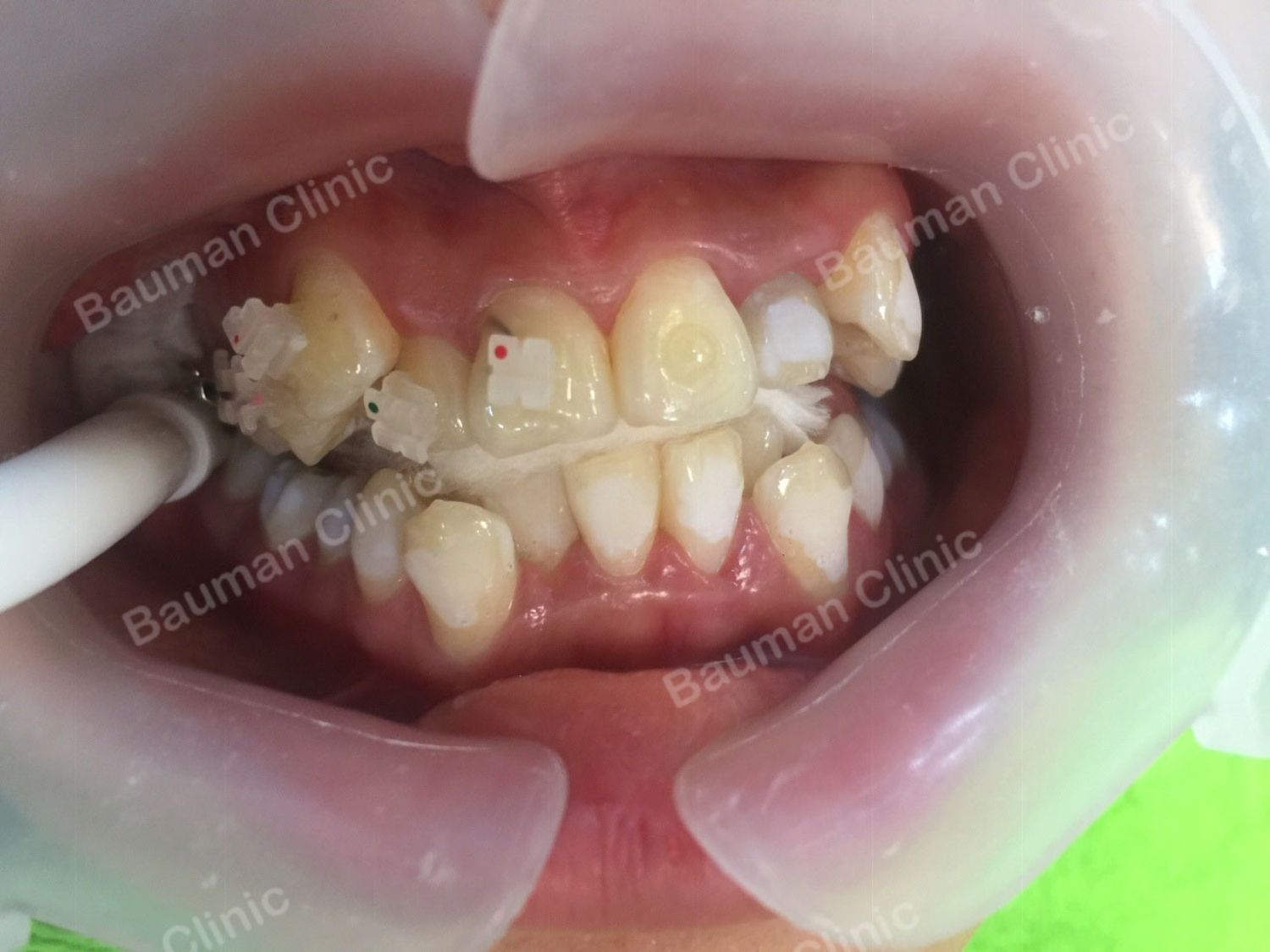 Ca niềng răng số 5059 - Nha khoa Bauman Clinic