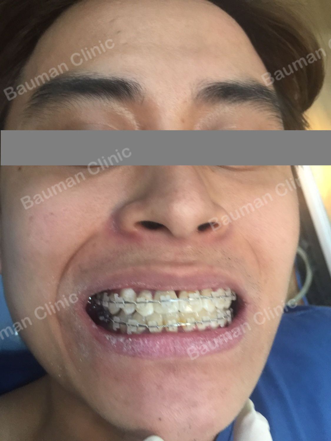 Ca niềng răng số 5061 - Nha khoa Bauman Clinic