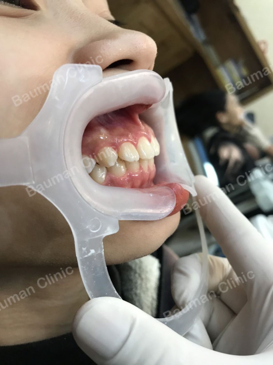 Ca niềng răng số 5095 - Nha khoa Bauman Clinic