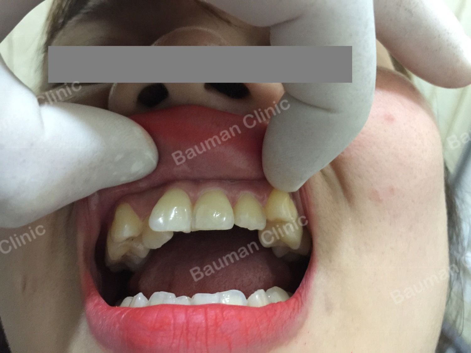 Ca niềng răng số 5036 - Nha khoa Bauman Clinic
