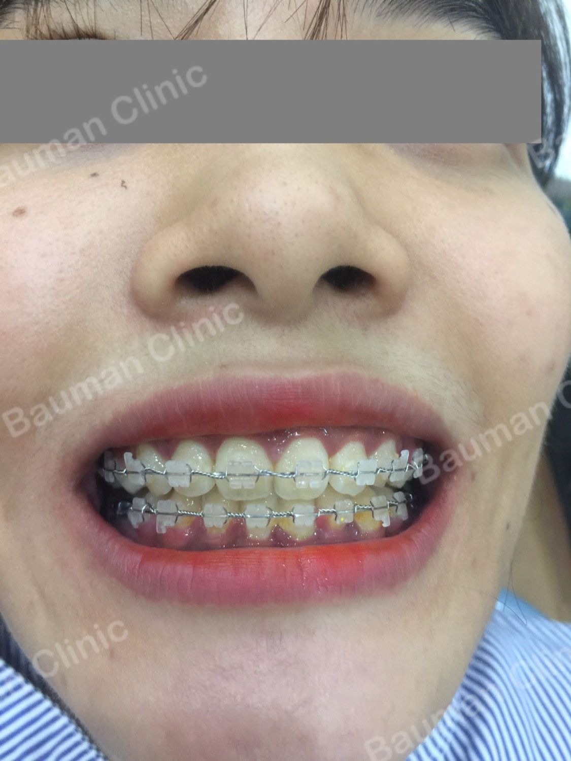 Ca niềng răng số 5039 - Nha khoa Bauman Clinic