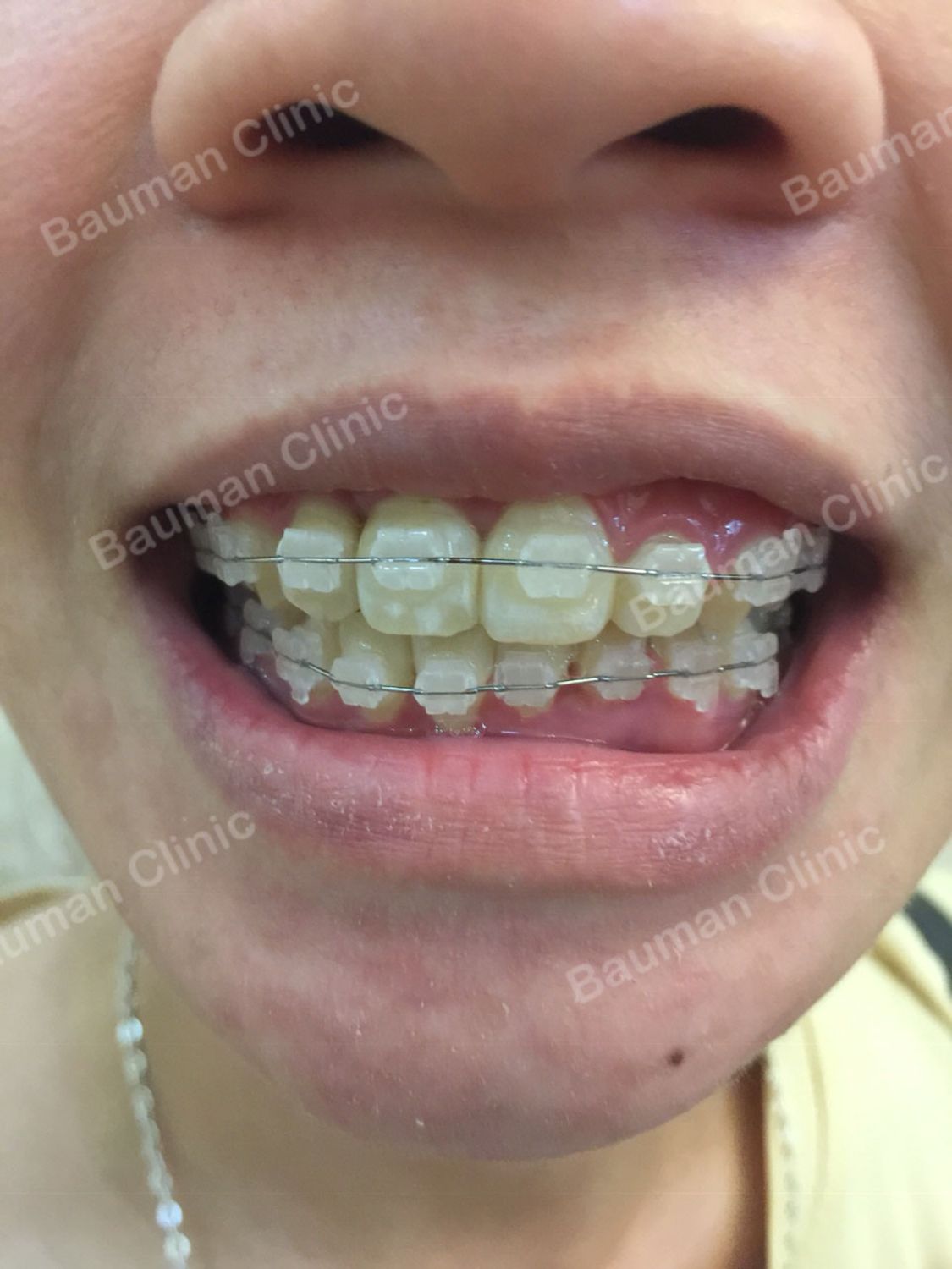 Ca niềng răng số 5075 - Nha khoa Bauman Clinic