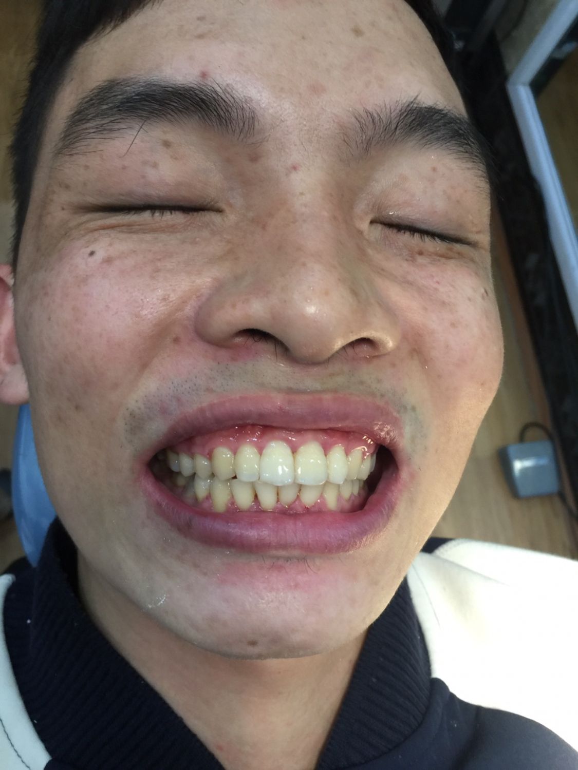 Ca niềng răng số 5034 - Nha khoa Bauman Clinic