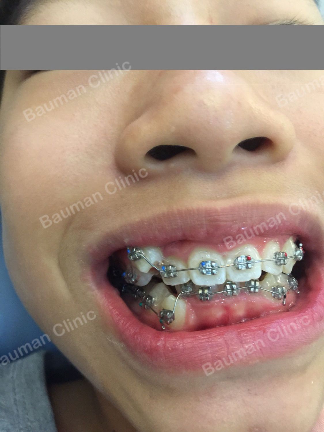 Ca niềng răng số 5054 - Nha khoa Bauman Clinic