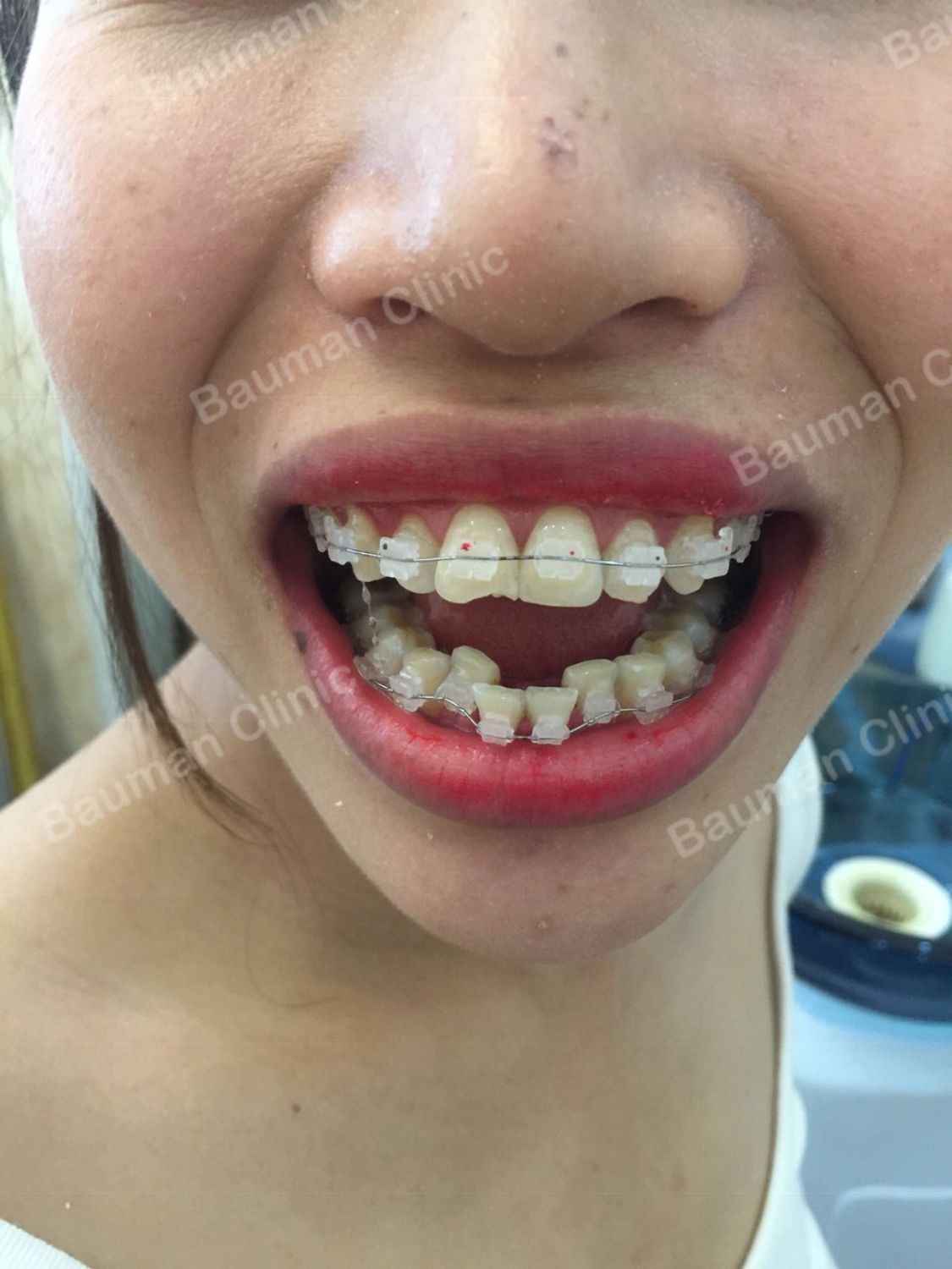 Ca niềng răng số 5057 - Nha khoa Bauman Clinic
