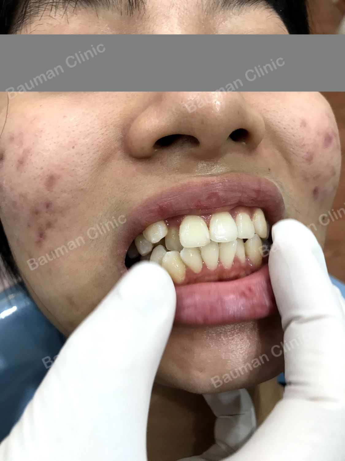 Ca niềng răng số 5018 - Nha khoa Bauman Clinic
