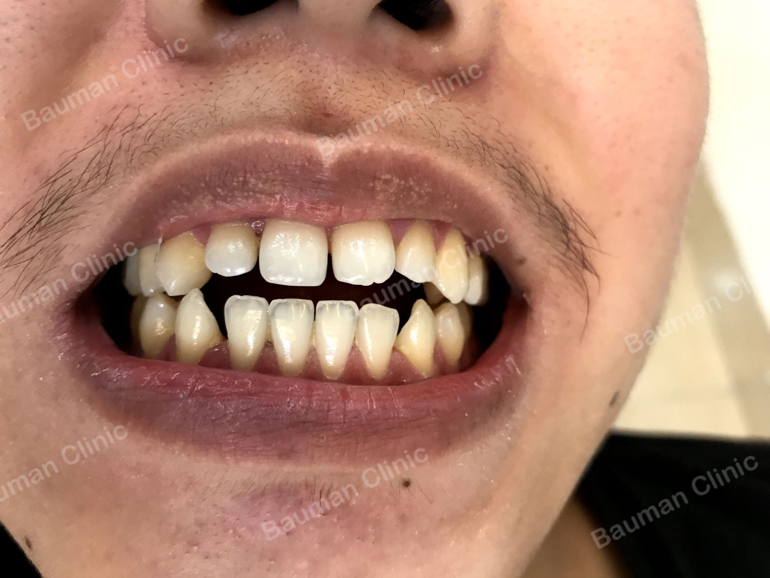 Ca niềng răng số 5008 - Nha khoa Bauman Clinic
