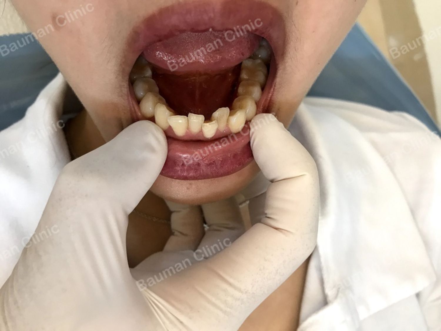 Ca niềng răng số 5006 - Nha khoa Bauman Clinic