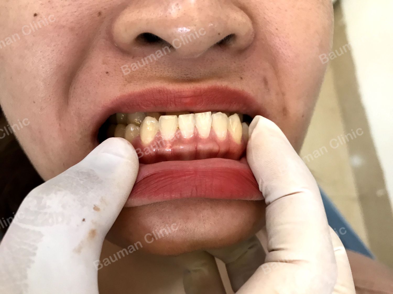 Ca niềng răng số 5009 - Nha khoa Bauman Clinic