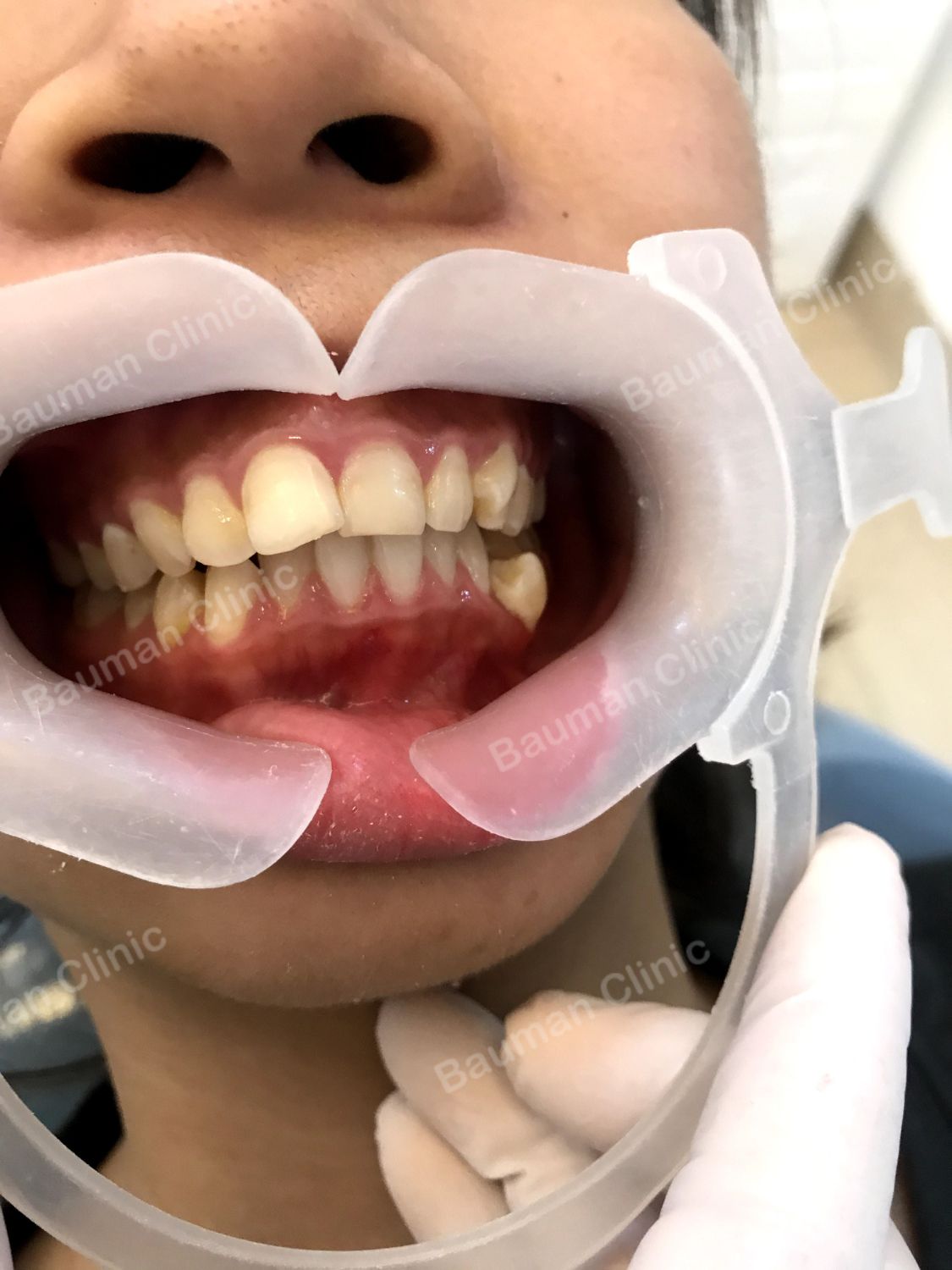 Ca niềng răng số 5007 - Nha khoa Bauman Clinic